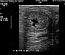 Breeding-induced endometritis in a mare.