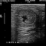 Breeding-induced endometritis in a mare.